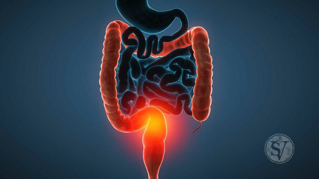 Ulcerative Colitis